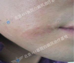 北京白癜风治疗医院：男性嘴角局限型白癜风2年