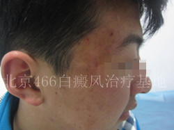 北京白癜风专科医院：男性面部白癜风三个月