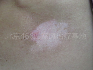北京白癜风专科医院：男性胸部白癜风半年