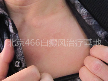 北京白癜风专科医院：男性胸部白癜风半年