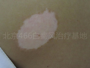 北京白癜风专科医院：女性背部白癜风2年