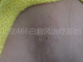 北京白癜风专科医院：女性背部白癜风2年